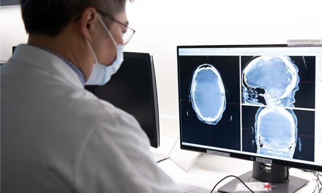 Cleveland Clinic advierte sobre el meningioma, el tumor cerebral más frecuente en adultos