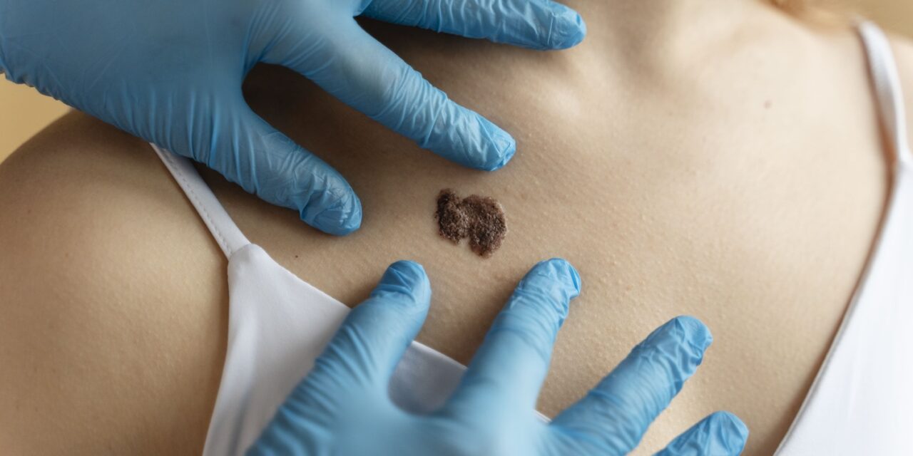 Estado aprueba tratamiento para melanoma, pero pacientes siguen sin poder acceder