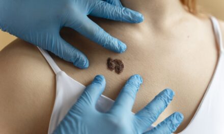 Estado aprueba tratamiento para melanoma, pero pacientes siguen sin poder acceder